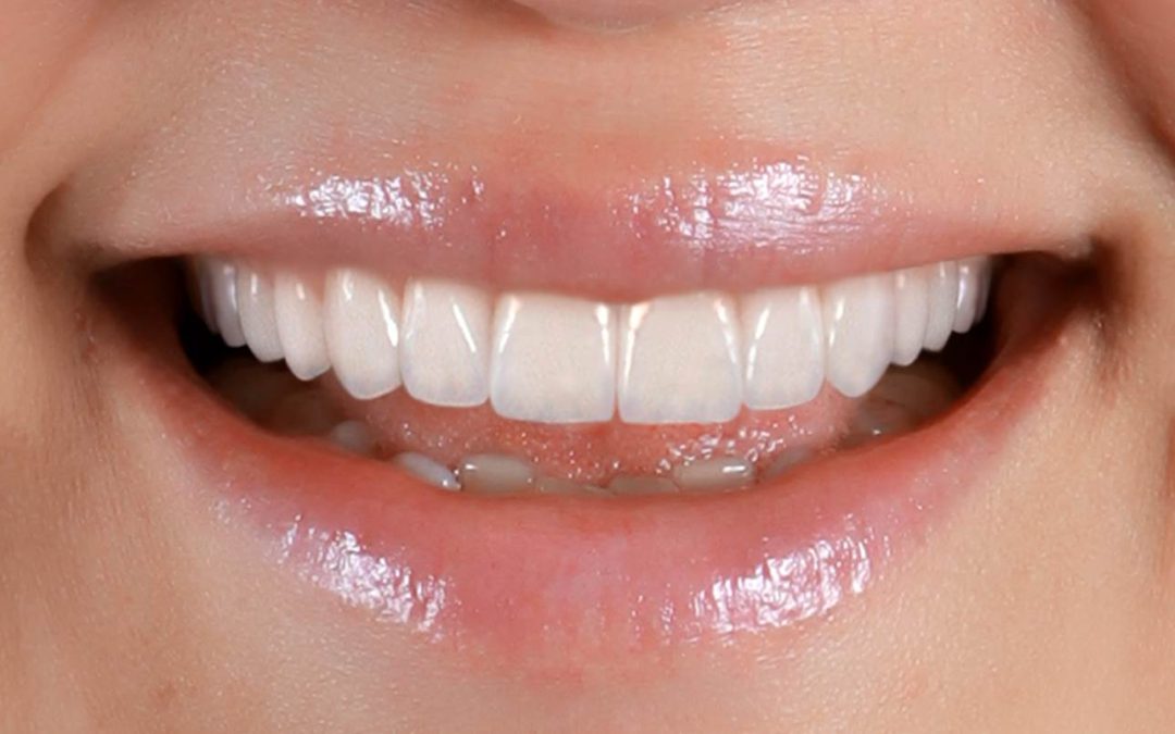 Woman teeth smiling veneer
